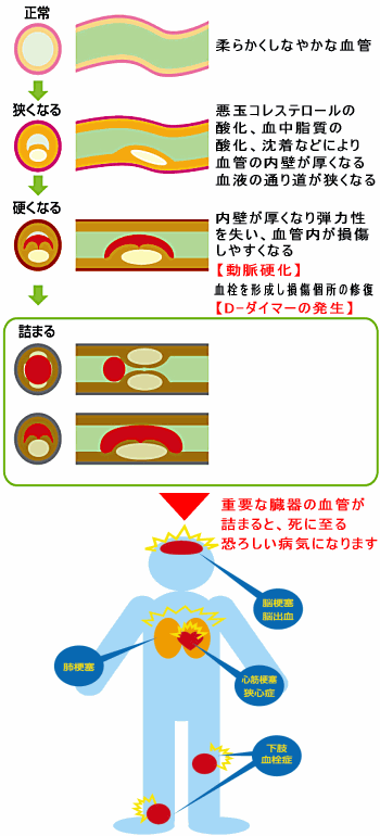 動脈硬化と血栓